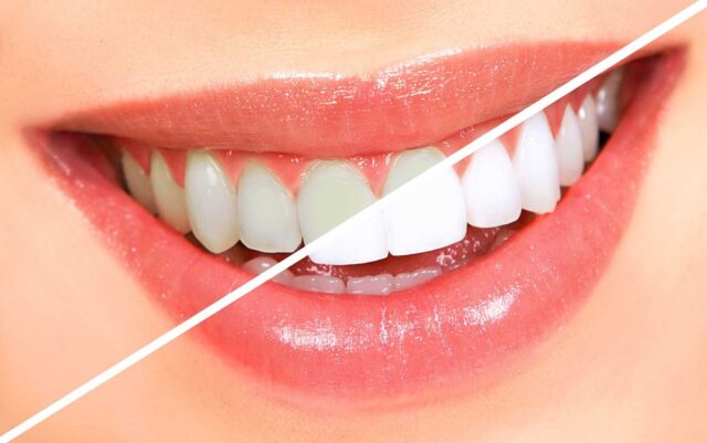 teeth whitening 