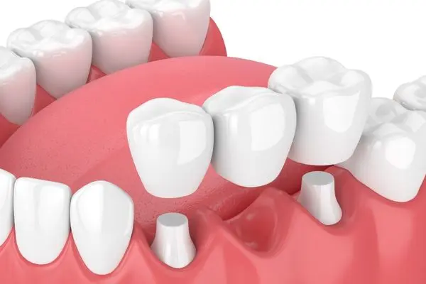 dental bridge miami