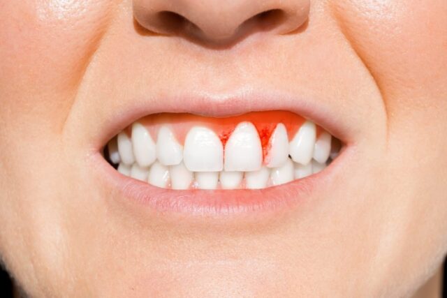 gingivitis