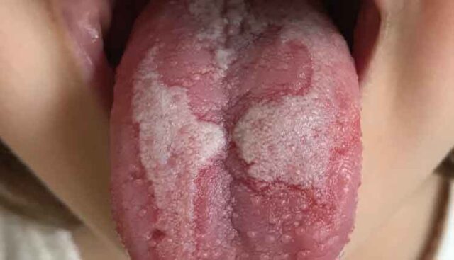 glossitis