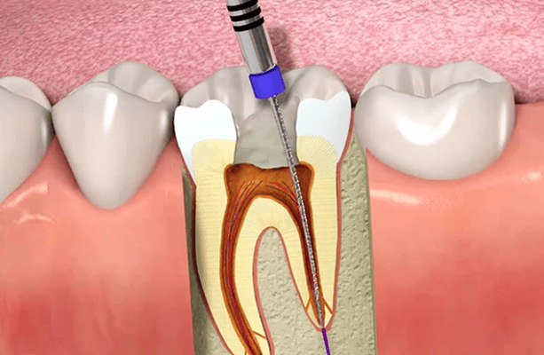 root canal treatment