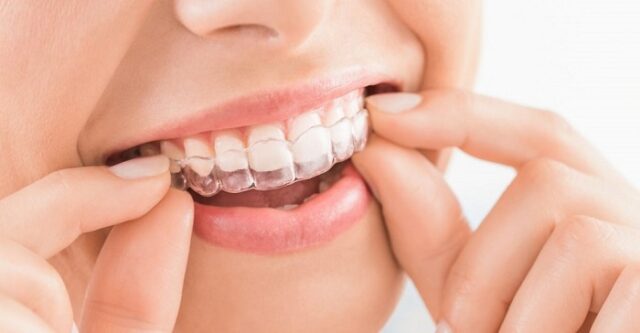 clear aligners 