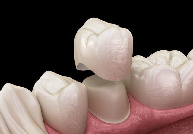 dental crown 